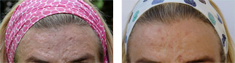 Before and after treatment for acne