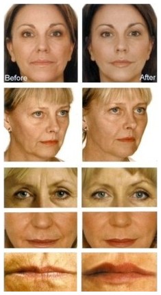 Dermal Fillers can be used to enhance the facial contours, facial lines and wrinkles particularly around the eyes, nose and lips.