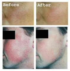 Facial Thread Veins before and after treatment
